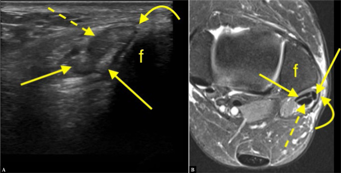 Comparative analysis of ultrasound and magnetic resonance imaging in diagnosing pain in the posterolateral region of the ankle.