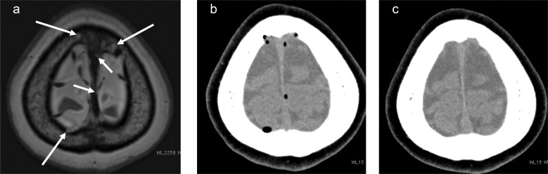 Intracranial Air Absorption through Arachnoid Granulation: New Considerations from Transsphenoidal Surgery and Implications for Neurofluid Dynamics.