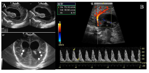Breast milk-associated late-onset group B streptococcus sepsis in preterm triplets: A case report and literature review.