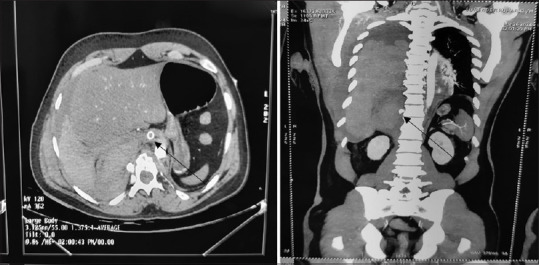 Massive Hemothorax due to a Rare Entity: Dilemma of ICD Insertion!! A Case Report.