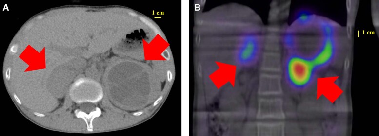 Remission of Insulin-Dependent Diabetes Mellitus in Multiple Endocrine Neoplasia Type 2A After Adrenalectomy.