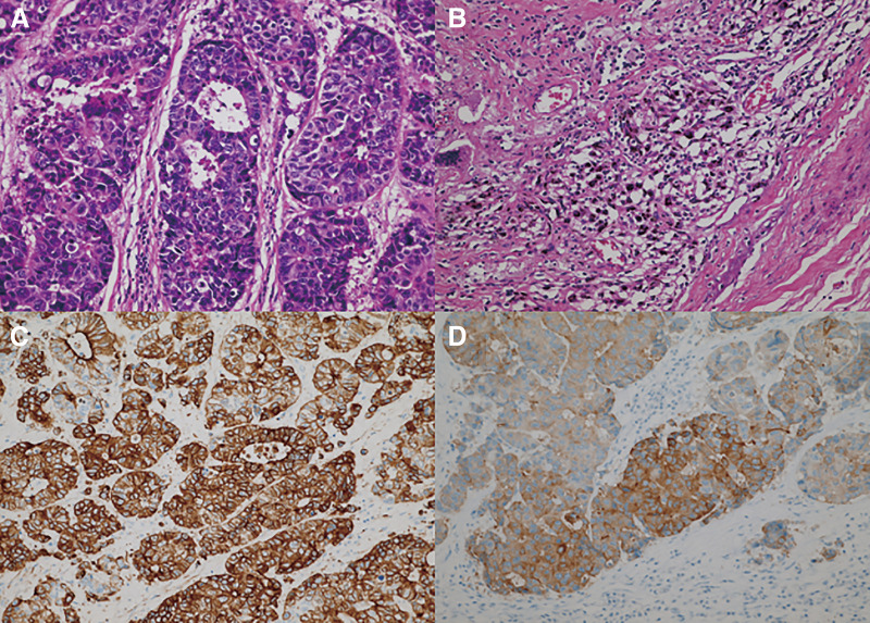 Long-Term Survival after Treatment with Induction Therapy and Surgery for Mediastinal Carcinoma of Unknown Primary.