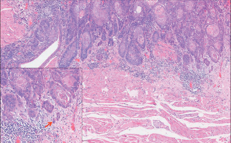 Tumor Budding as an Independent Prognostic Histopathological Marker in Oral Squamous Cell Carcinoma - An Indian Tertiary Care Center Experience.