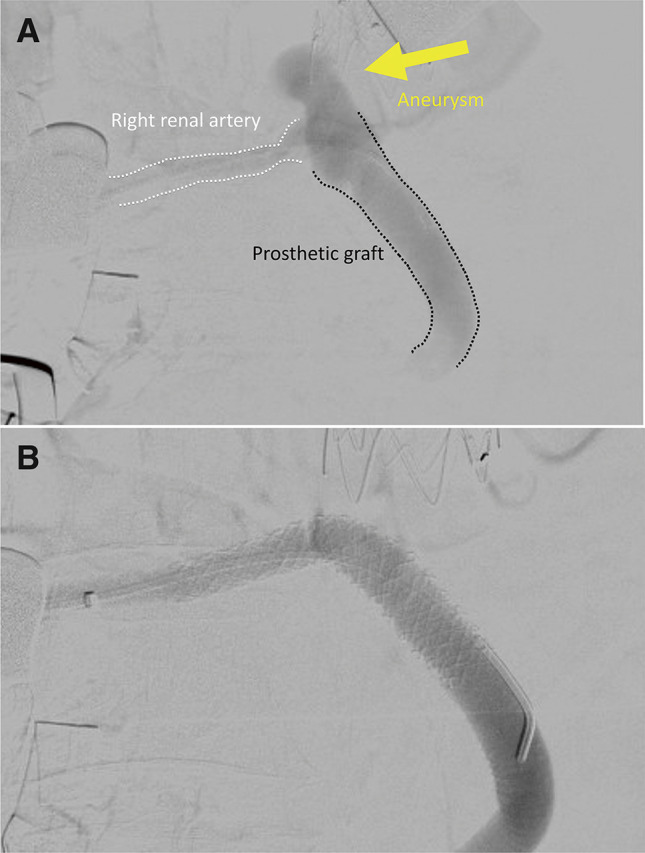Renal Artery Stent-Graft Implantation Using the Retrograde Approach in a Patient Who Developed a Renal Artery Aneurysm after Thoracoabdominal Aortic Repair.