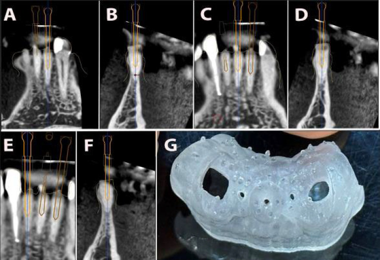 Guided Endodontic Technique in Mandibular Incisors with Pulp Canal Obliteration: A Case Report.
