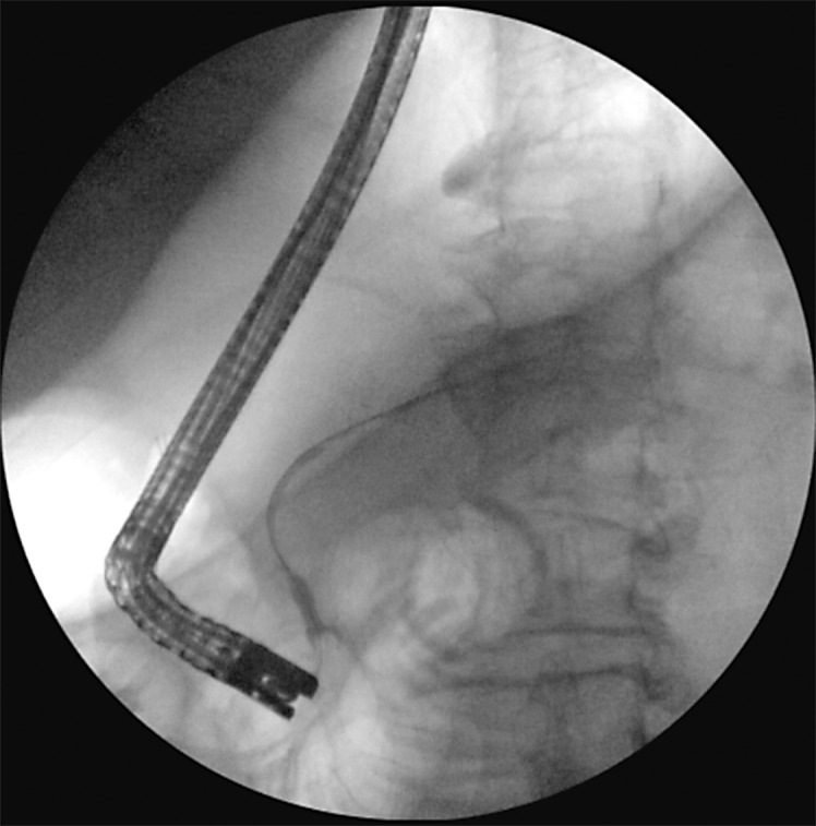 Colitis-Induced Pancreatic Fistula with Pancreatic Ascites.