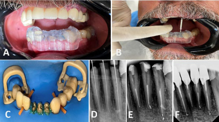 Guided Endodontic Technique in Mandibular Incisors with Pulp Canal Obliteration: A Case Report.