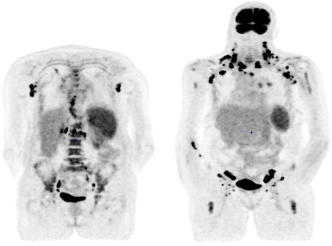 When the mask slips: A peripheral T-cell lymphoma disguised as lupus with myelofibrosis in a patient with May-Hegglin syndrome