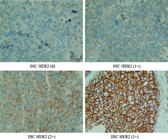 Impact of HER2 Expression on the Prognosis of Muscle-Invasive Bladder Cancer Patients Treated with Bladder-Preservation Comprehensive Therapy.