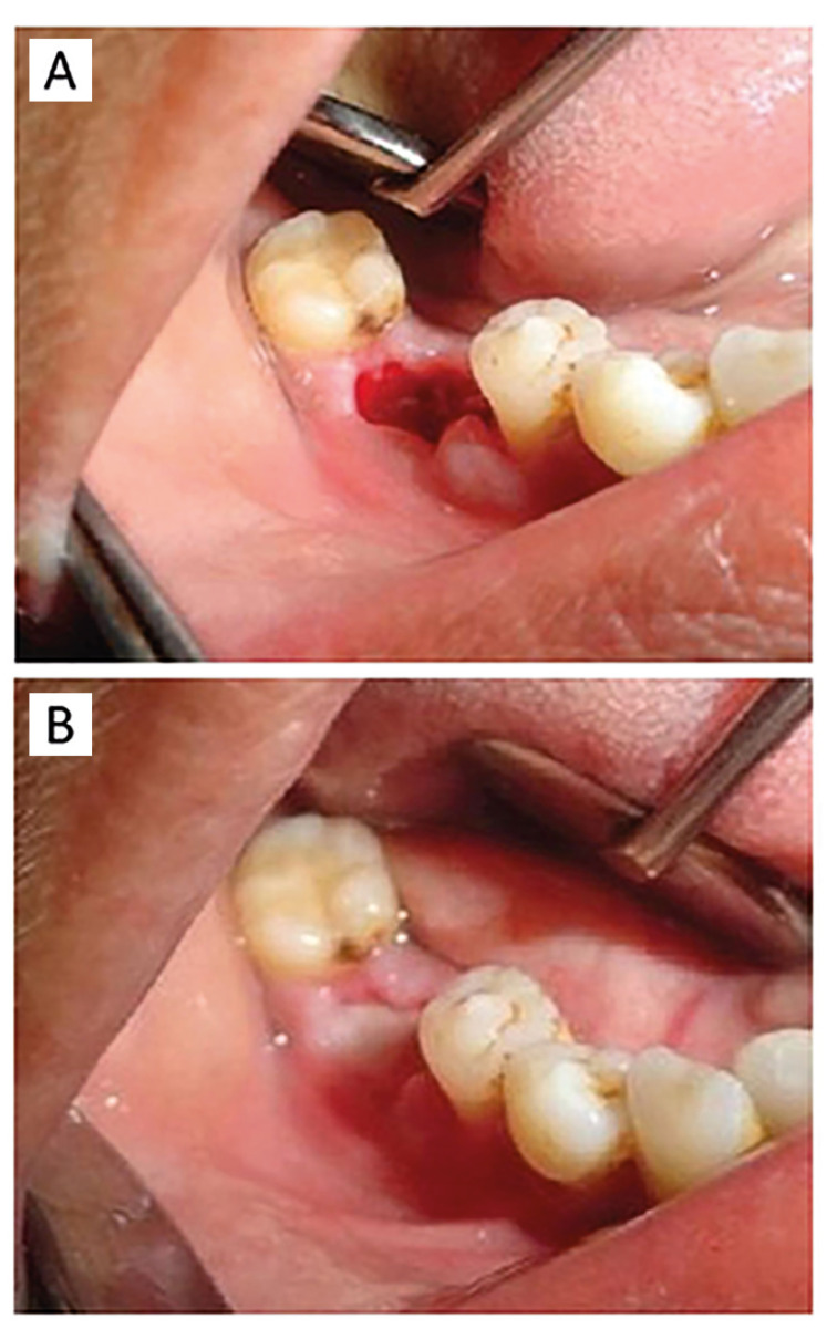 Novel topical dressing for dry socket and comparison of its efficacy with that of Alvogyl®: A randomized controlled clinical trial.