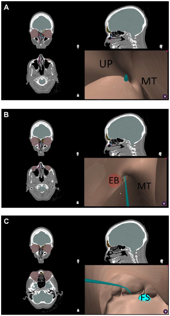 Semi-Automated Virtual Endoscopy of the Frontal Recess.
