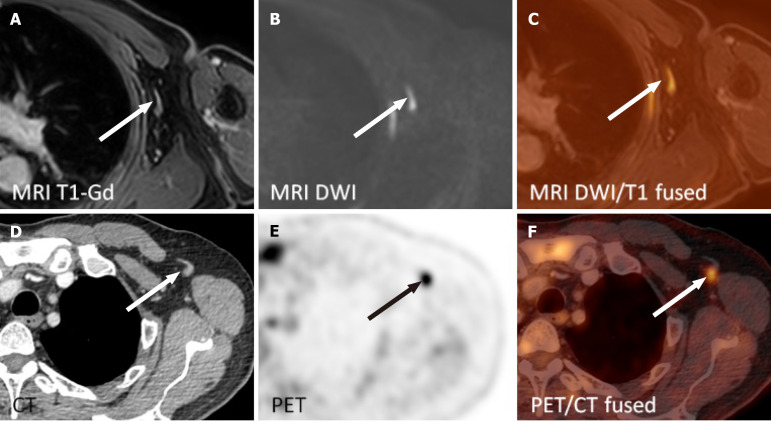 Whole-body magnetic resonance imaging provides accurate staging of diffuse large B-cell lymphoma, but is less preferred by patients.