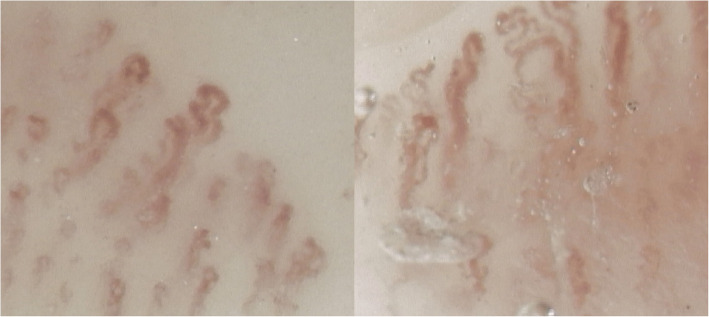 Reversibility of acrocyanosis and improvement of capillaroscopic pattern in a patient with polycythemia vera treated with ruxolitinib: a case report.