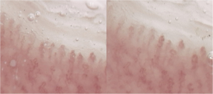 Reversibility of acrocyanosis and improvement of capillaroscopic pattern in a patient with polycythemia vera treated with ruxolitinib: a case report.