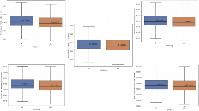 Smoking predicts brain atrophy in 10,134 healthy individuals and is potentially influenced by body mass index.