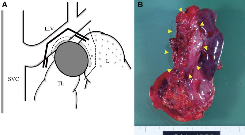 Long-Term Survival after Treatment with Induction Therapy and Surgery for Mediastinal Carcinoma of Unknown Primary.