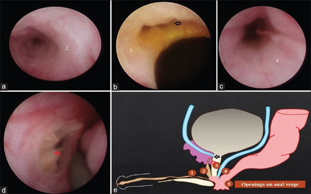 Urethral duplication with five openings in anal canal: A novel case report.