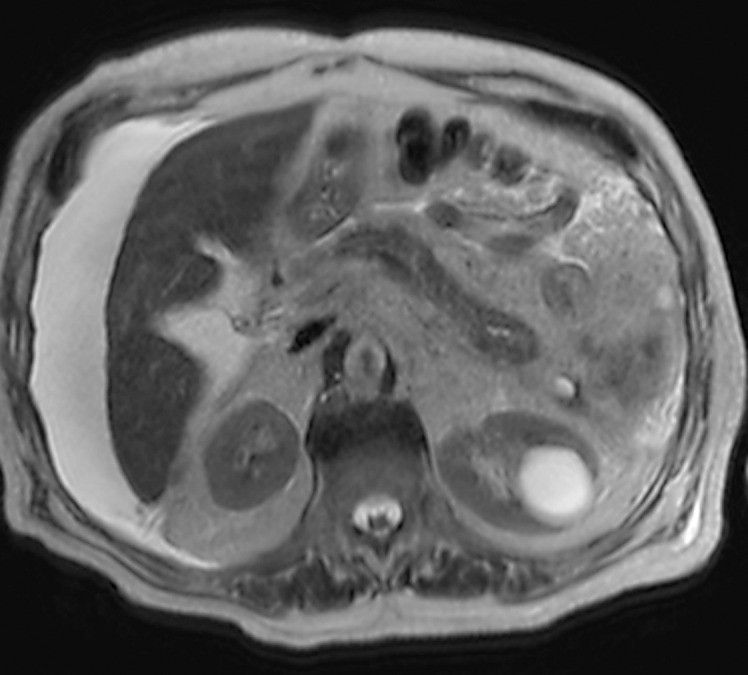 Colitis-Induced Pancreatic Fistula with Pancreatic Ascites.