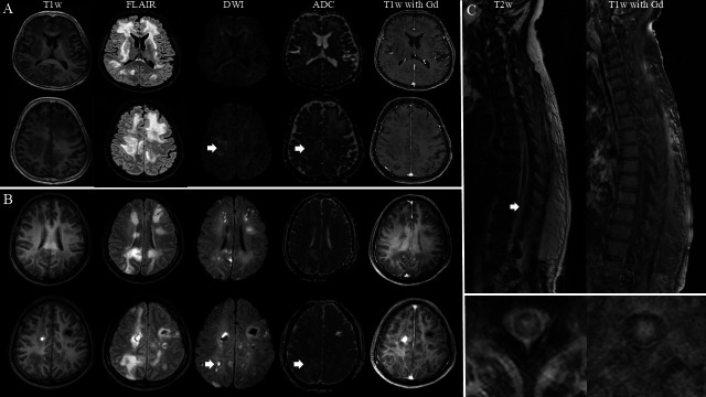 Clinical manifestations and outcomes of patients with intravascular large B-cell lymphoma with neurological involvement: highlighting longitudinally extensive myelopathy as a distinct feature.