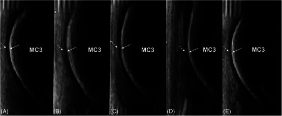 Ultrasonographic assessment of equine metacarpal cartilage thickness is more accurate than computed tomographic arthrography.