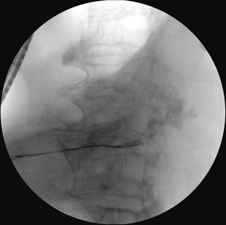 Colitis-Induced Pancreatic Fistula with Pancreatic Ascites.