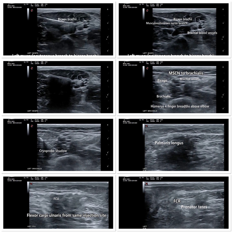 A Case Report of Cryoneurolysis With Factor VIII Administration for Cerebral Palsy-related Spasticity in a Patient With Hemophilia A.