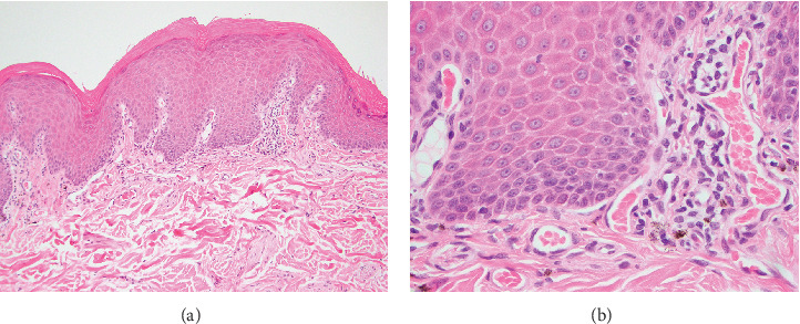 Anterior Uveitis and Uveal Depigmentation in a Dog With Vitiligo.