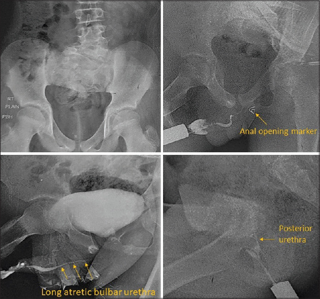 Urethral duplication with five openings in anal canal: A novel case report.