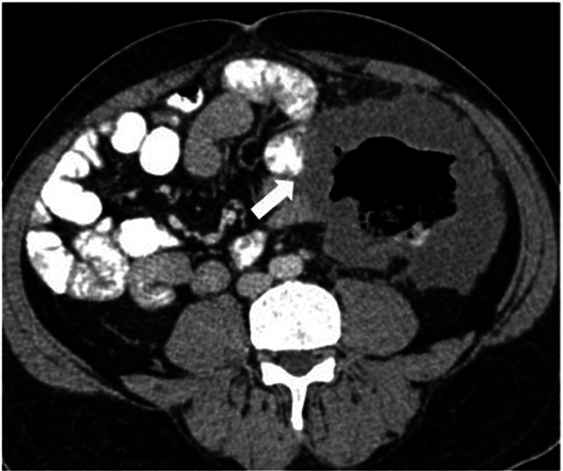 CT and MR Imaging in Colorectal Carcinoma: A Tool for Diagnosis, Staging, Response Evaluation, and Follow-Up.