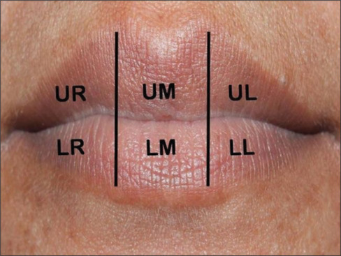 Dermatoglyphics and cheiloscopy in inheritance of oral clefts in North Indian population.