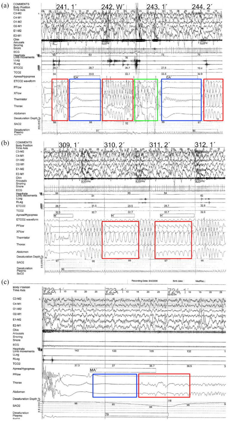 Sleep and breathing in children with Joubert syndrome and a review of other rare congenital hindbrain malformations.