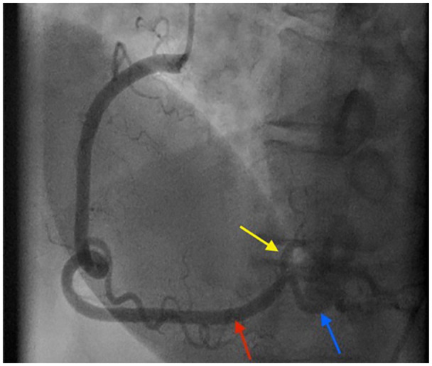 Premature Coronary Artery Disease Presenting as STEMI in a Teenager.