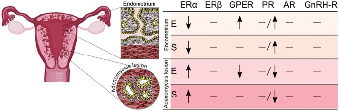 Hormone receptor profile of ectopic and eutopic endometrium in adenomyosis: a systematic review.