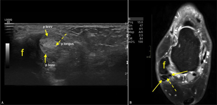Comparative analysis of ultrasound and magnetic resonance imaging in diagnosing pain in the posterolateral region of the ankle.