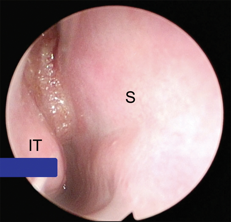 HPV-associated Sinonasal Squamous Cell Carcinoma.