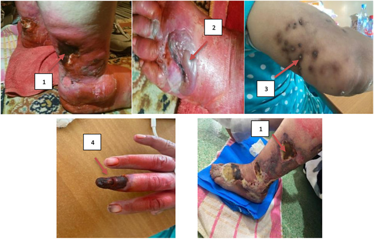 A Rare Case of Calciphylaxis: A Case Report.