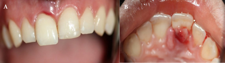 Management of Acute Apical Abscess Presenting with Rapid Extrusion of a Tooth: A Case Report.