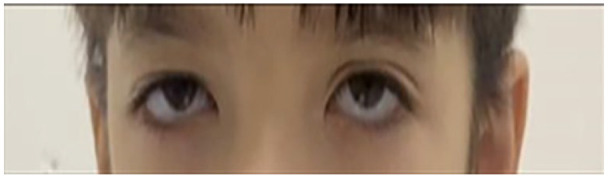 A Case of Rafiq Syndrome (MAN1B1-CDG) in a Palestinian Child, With Brief Literature Review of 44 Cases.