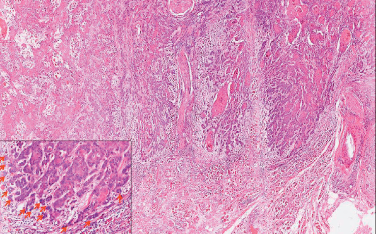 Tumor Budding as an Independent Prognostic Histopathological Marker in Oral Squamous Cell Carcinoma - An Indian Tertiary Care Center Experience.