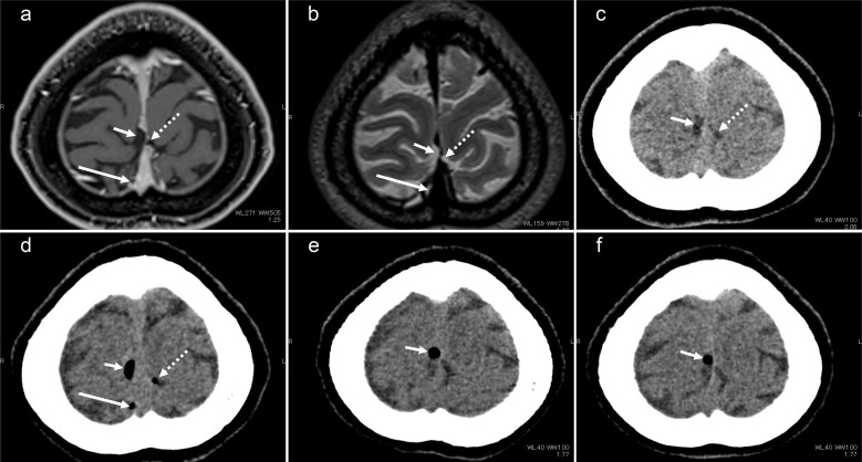 Intracranial Air Absorption through Arachnoid Granulation: New Considerations from Transsphenoidal Surgery and Implications for Neurofluid Dynamics.