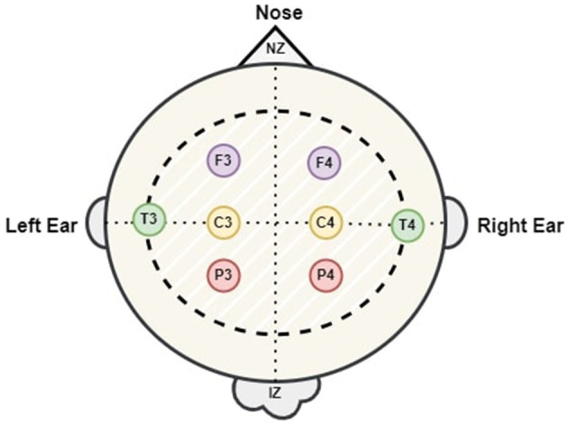EEG electrode setup optimization using feature extraction techniques for neonatal sleep state classification.