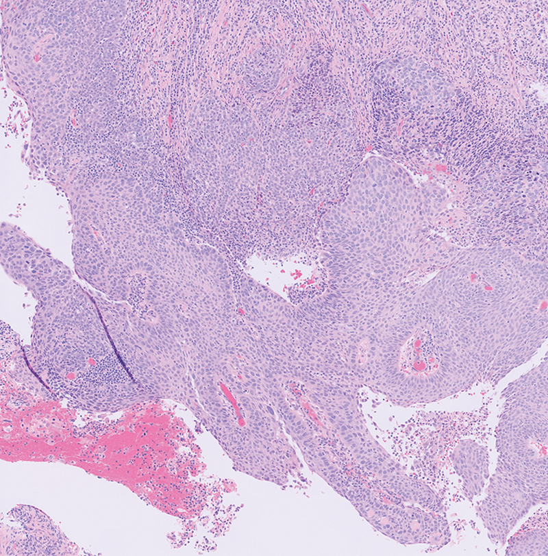 HPV-associated Sinonasal Squamous Cell Carcinoma.