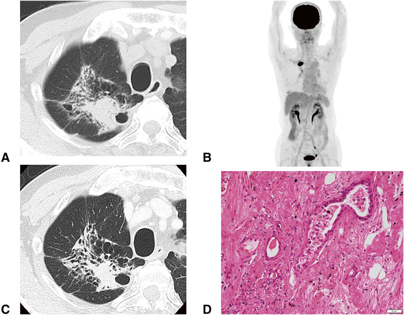Delayed Onset Immune-Related Pituitary Adrenal Insufficiency Induced by Neoadjuvant Nivolumab Therapy for Locally Advanced Lung Cancer in the Postoperative Period: A Case Report.