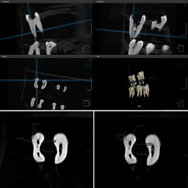 Apical Transportation and Centering Ability of Trunatomy, Edmax, and Reciproc Blue in Curved Mesiobuccal Canals of Mandibular Molars.