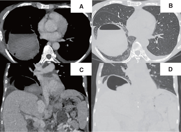 Pneumatocele Development after Deceased-Donor Liver Transplantation for Multiple Hepatic Cysts due to Autosomal Dominant Polycystic Kidney Disease: A Case Report.