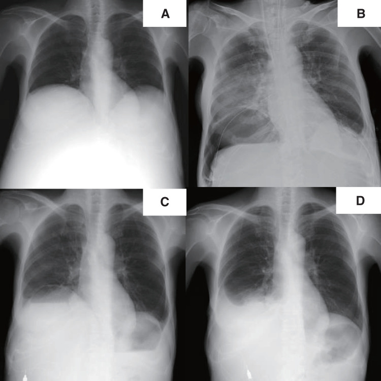 Pneumatocele Development after Deceased-Donor Liver Transplantation for Multiple Hepatic Cysts due to Autosomal Dominant Polycystic Kidney Disease: A Case Report.