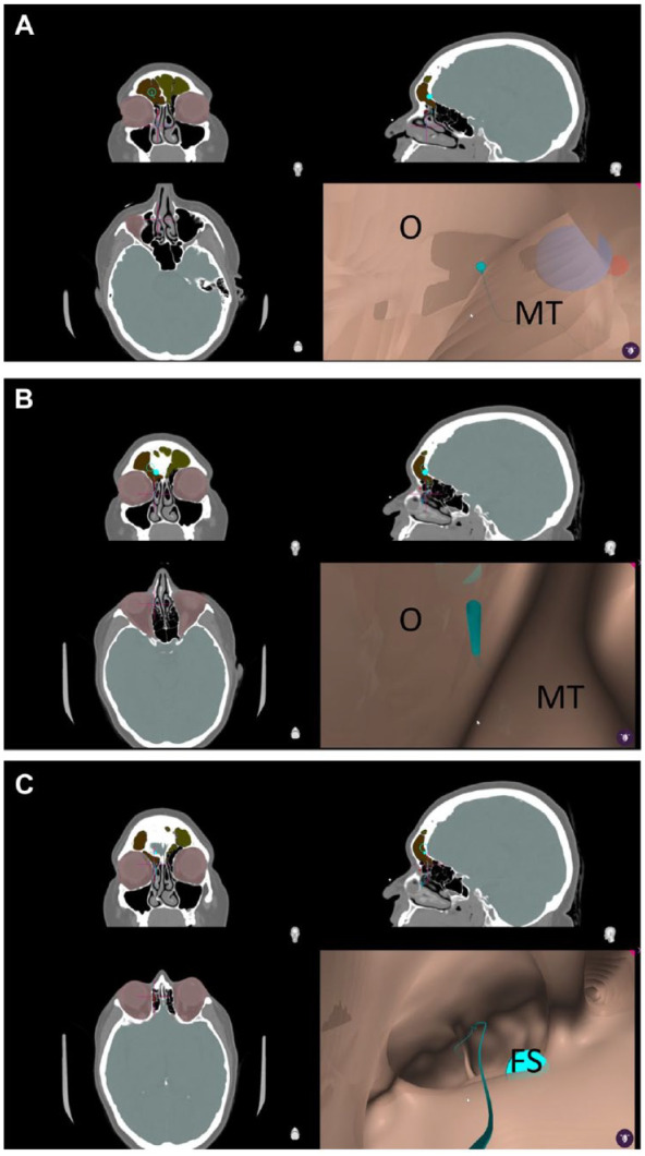 Semi-Automated Virtual Endoscopy of the Frontal Recess.