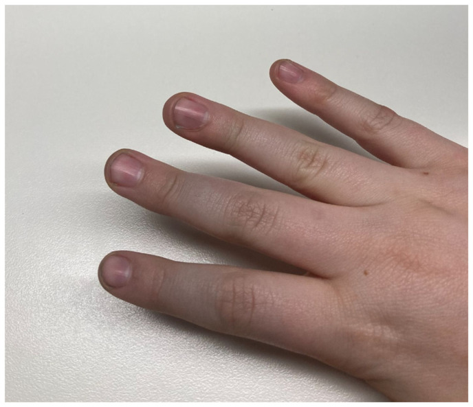Primary Raynaud's Phenomenon.