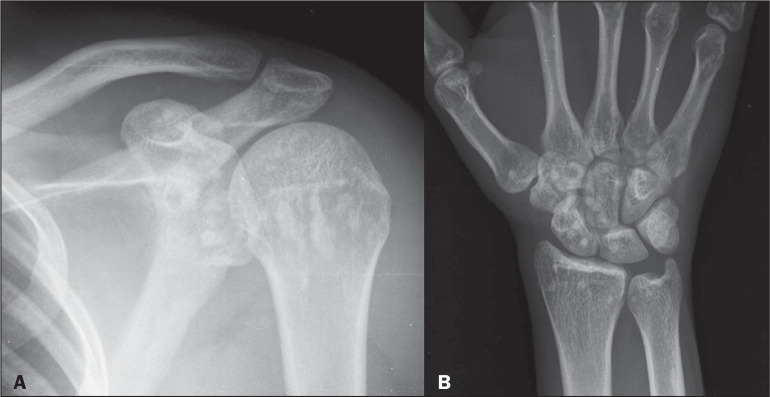 Sclerosing bone dysplasias: a pictorial essay.