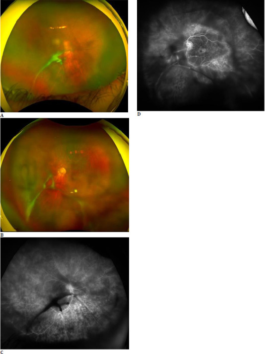 Fern-Like Pattern on Ultra-Widefield Fluorescein Angiography Across Various Uveitic Conditions.